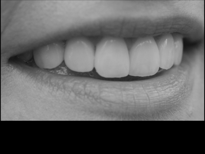 E max crowns and veneers