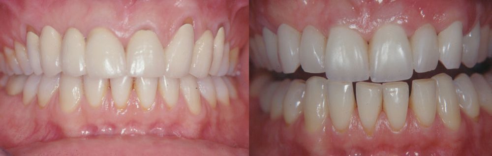 ANNA, ENHANCEMENT OF BEAUTY WITH FELDSPAR CERAMIC CROWNS