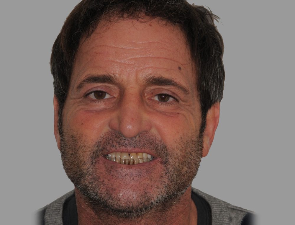 MAURIZIO, TOTAL REHABILITATION WITH ADDITIONAL FELDSPAR CERAMIC VENEERS