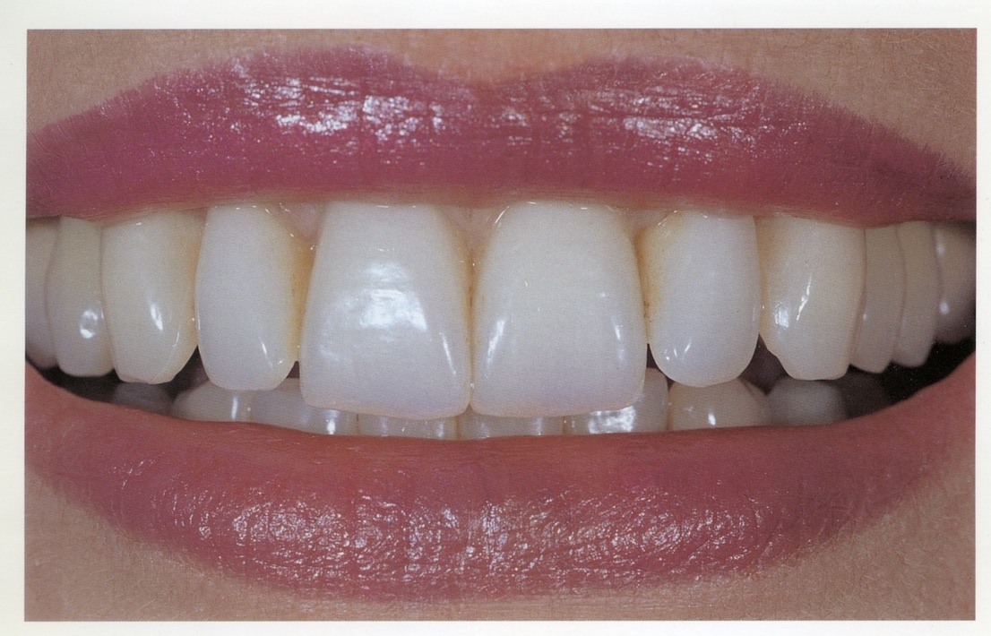 Red lips with dentures