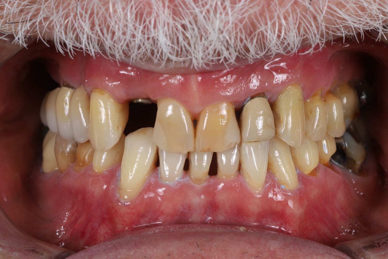 Case-2. Implant and Lithium di silikat crowns. Before .