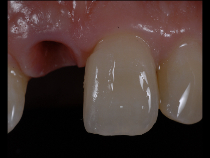 Partial mesial veneer try in before fitting of Zirconia implant