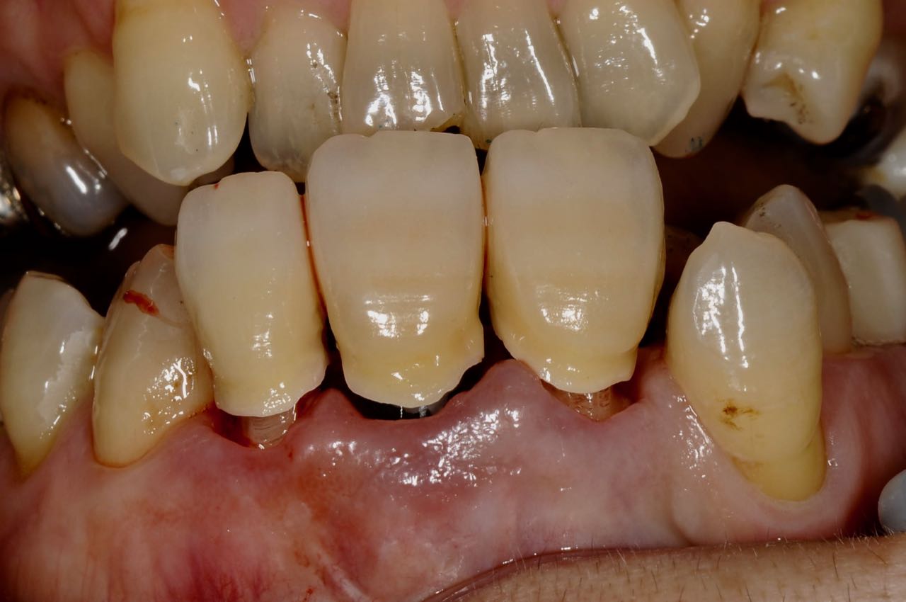 Case-3 Zirconia crown of three connected unit. Sub-Gingival contour given the appropriate contour