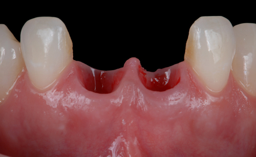 Case-2 Zr crowns. New situation 2019