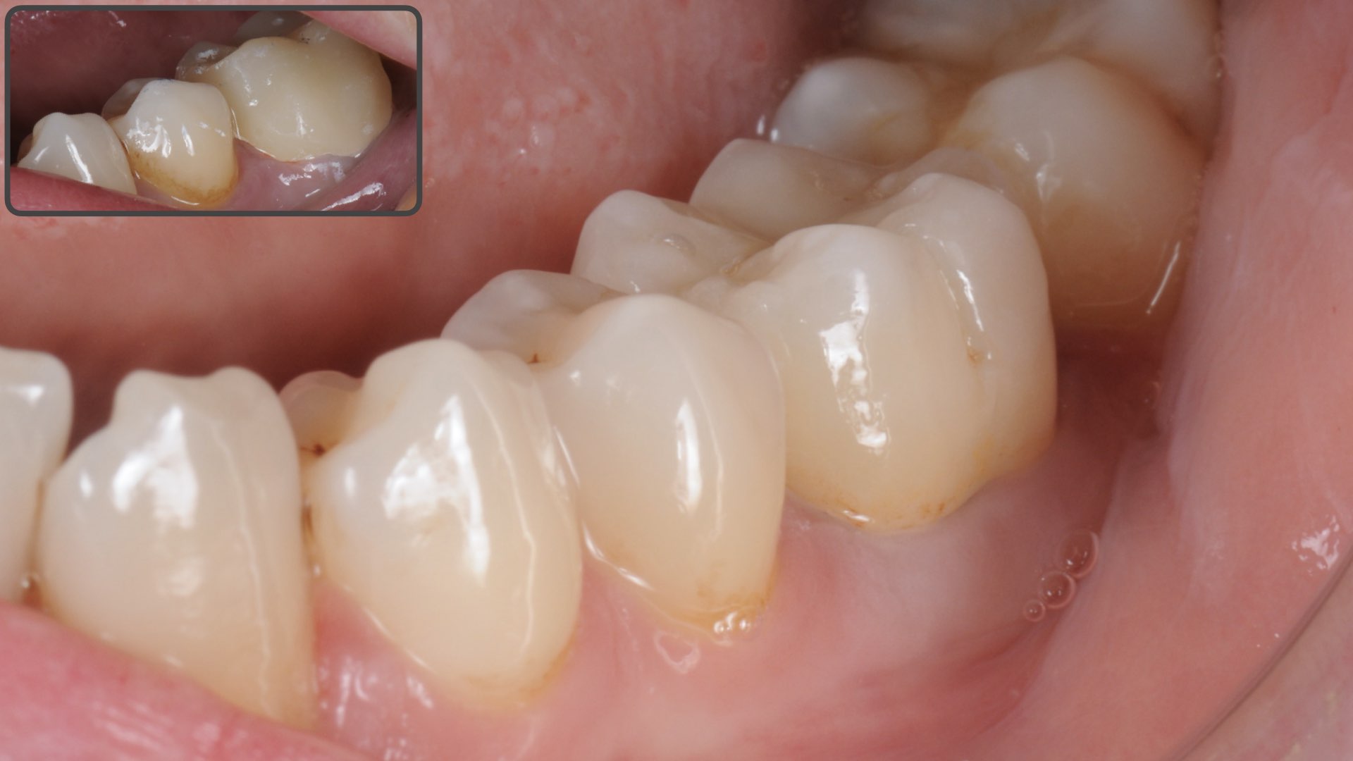 Clinical Case 4, picture 1 :  Improved aesthetics with a zirconia layered restoration on first molar