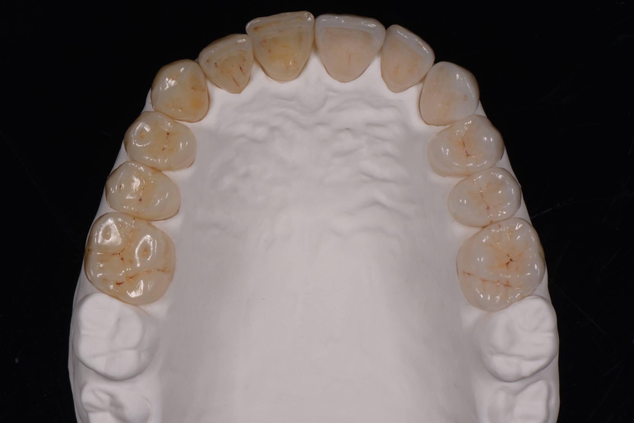 Lithium disilicate cutback technique monolithic incisal edge