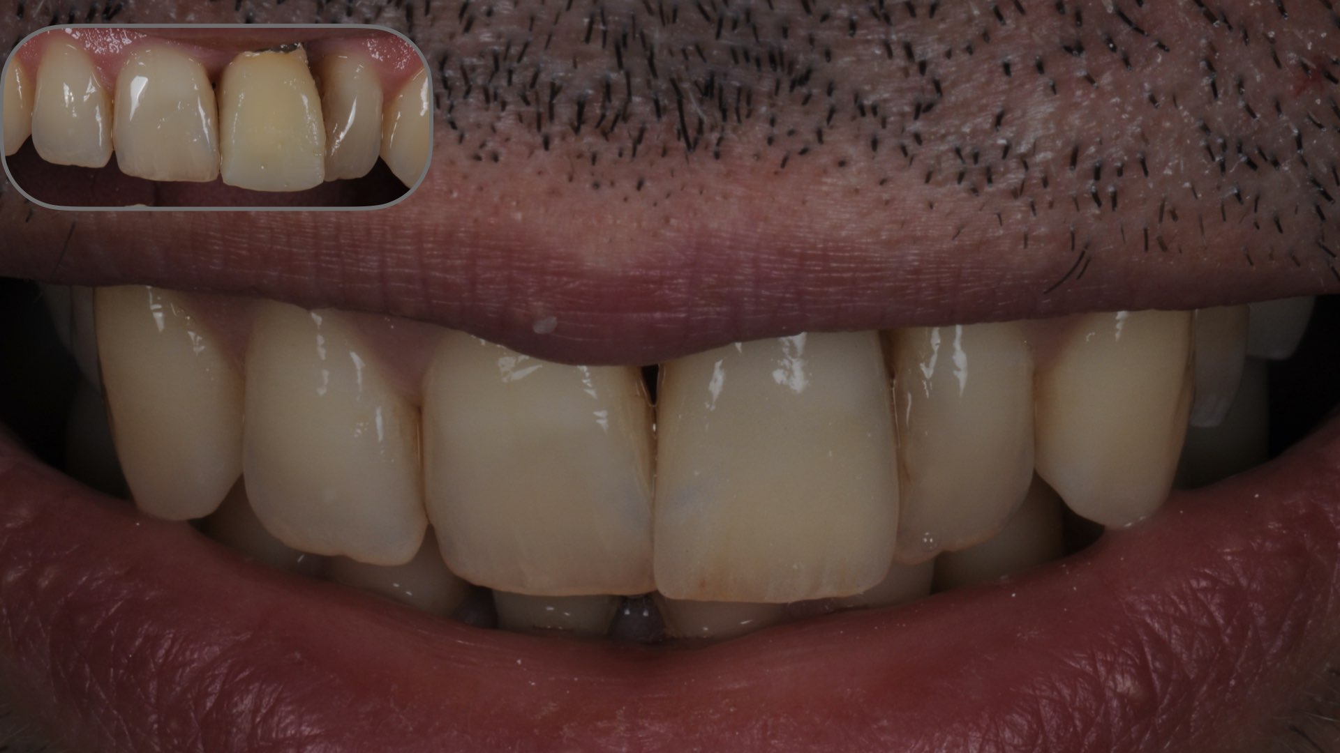 Clinical case 3:  Improved aesthetics with a zirconia layered restoration