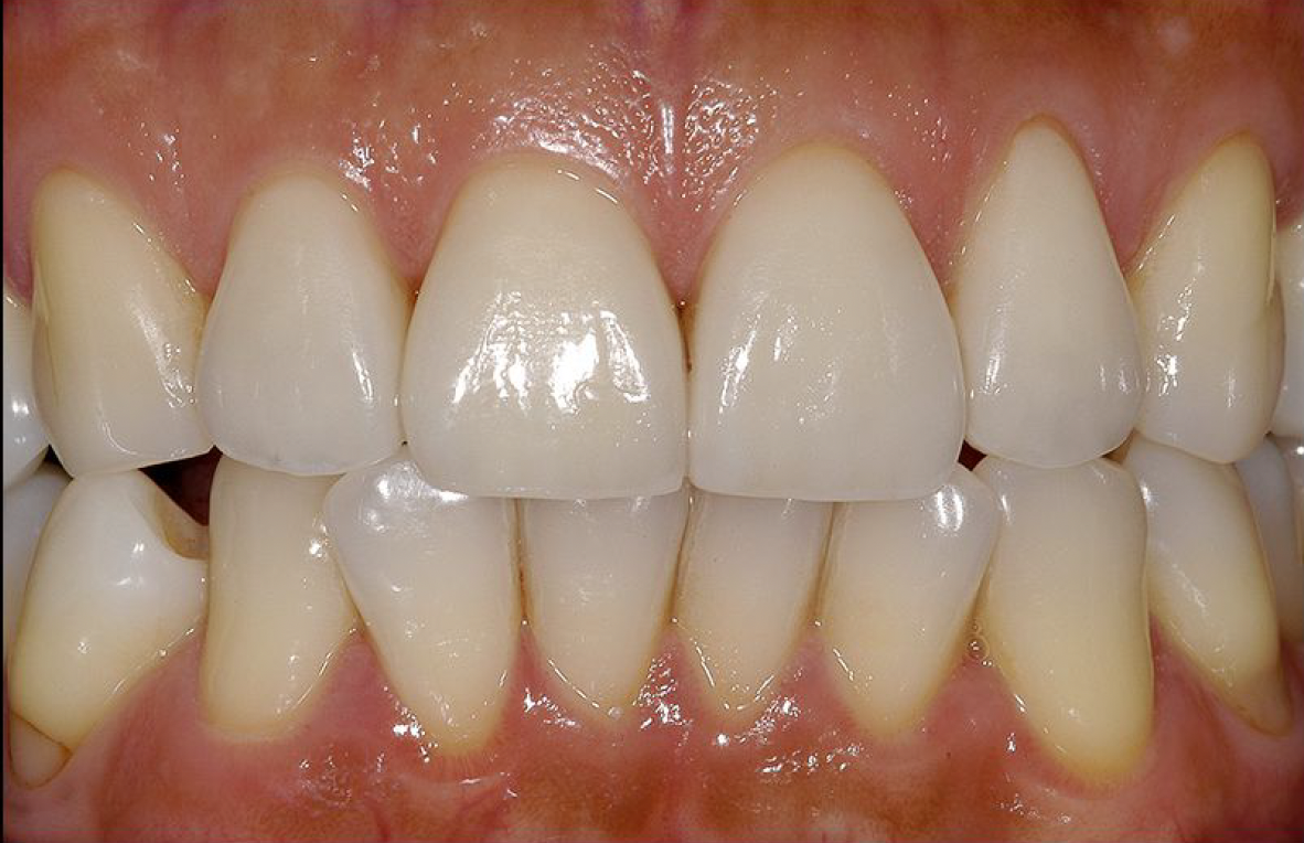 Porcelain Crowns and Veneers