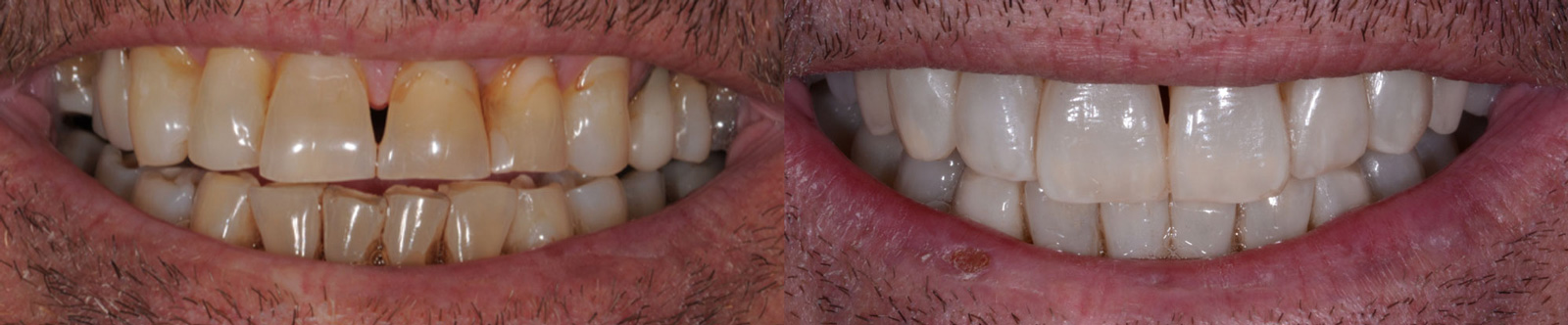 MAURIZIO, TOTAL REHABILITATION WITH ADDITIONAL FELDSPAR CERAMIC VENEERS