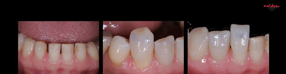  ROSI, TOTAL MIXED REHABILITATION WITH ADDITIONAL CROWNS AND VENEERS IN FELDSPAR CERAMIC