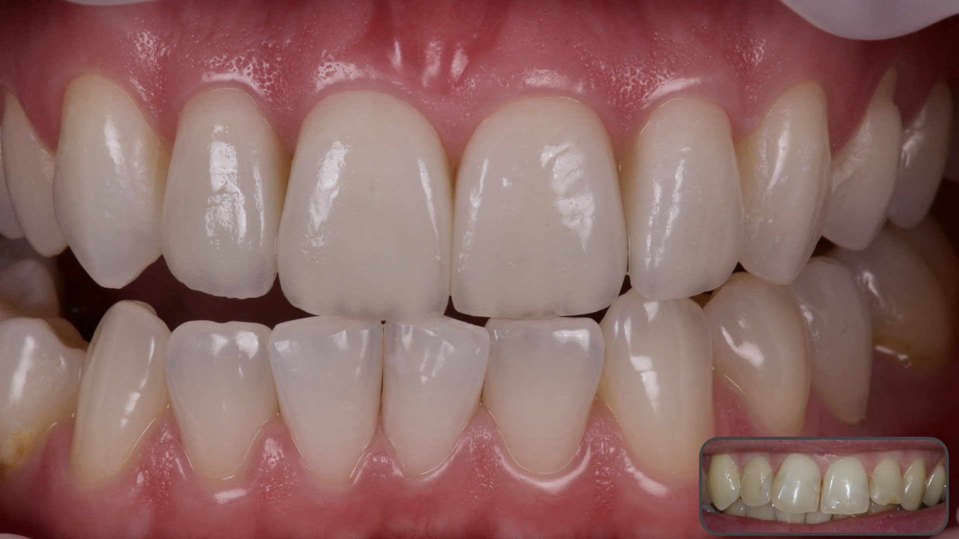 Clinical case 1 : Enhanced smile with 4 minimal prep veneers restoration on upper incisors