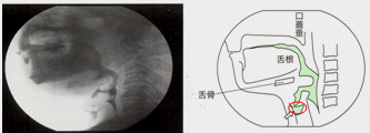 図8 嚥下前誤嚥