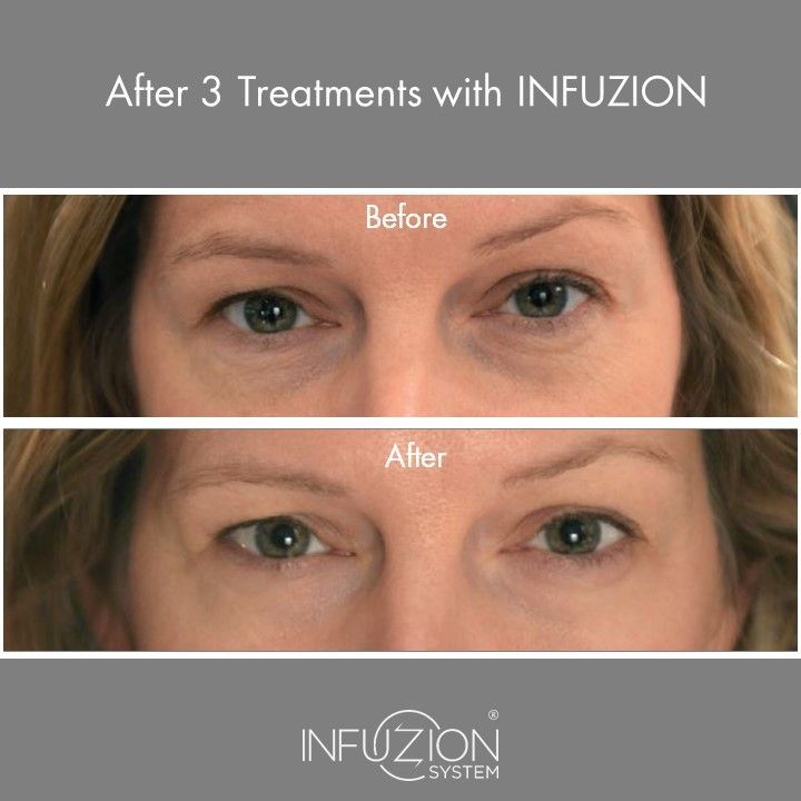 Infuzion – intensive Hautpflege für sichtbar verjüngtes Gesicht im Kosmetikinstitut Villa Kirnach