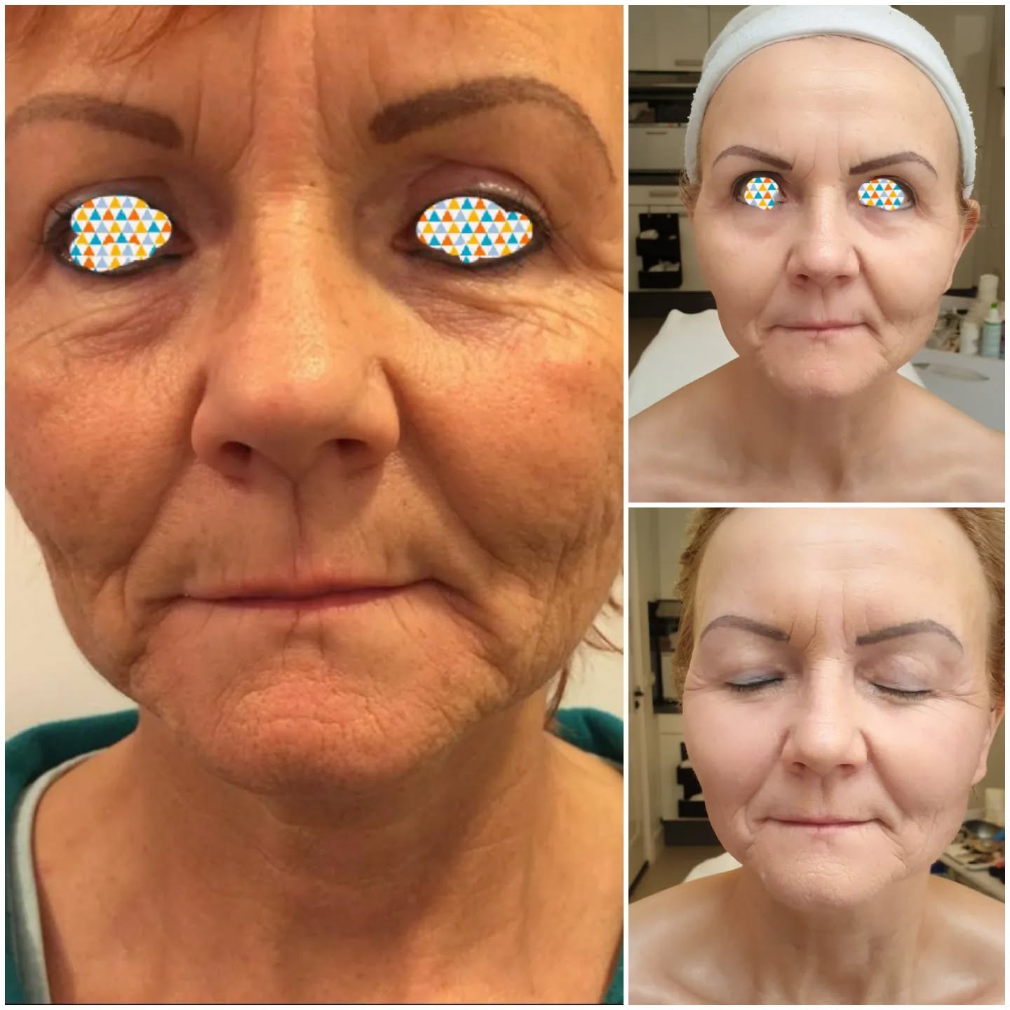 FaceDesign 5-1 nur nach einer Behandlung Mundkorrektur in der Villa Kirnach