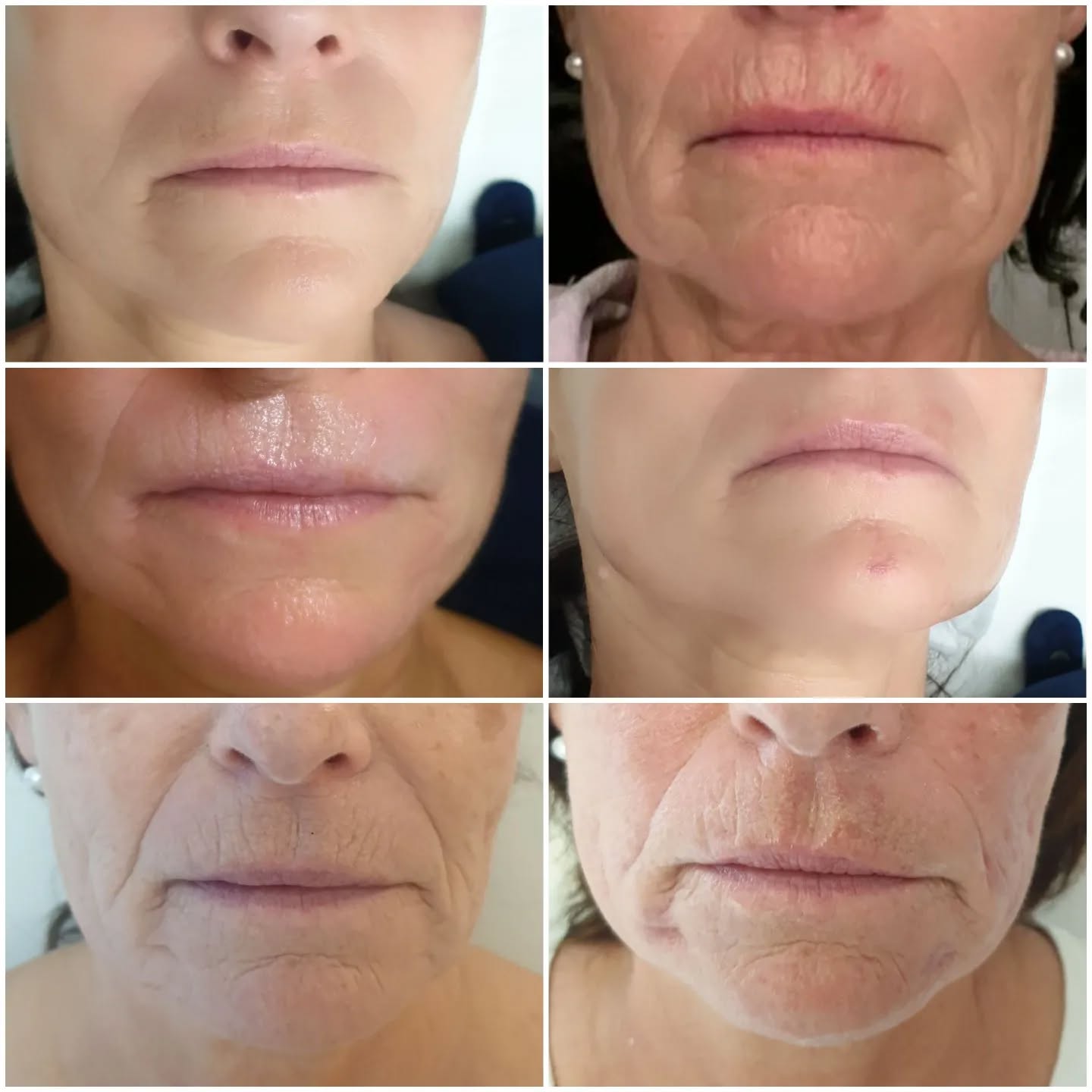 FaceDesign 12 er Kur danach regelmäßige Treatments im Kosmetikinstitut Villa Kirnach