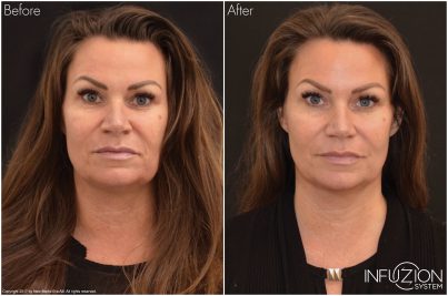Infuzion – intensive Hautpflege für sichtbar verjüngtes Gesicht im Kosmetikinstitut Villa Kirnach