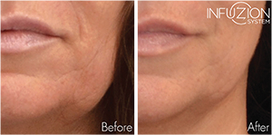 Infuzion System – Filler Effekt für sichtbar mehr Volumen und strahlendes Hautbild im Kosmetikinstitut Villa Kirnach