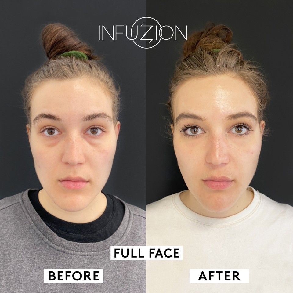 Infuzion – sichtbar glatteres Hautbild nach Behandlung im Kosmetikinstitut Villa Kirnach