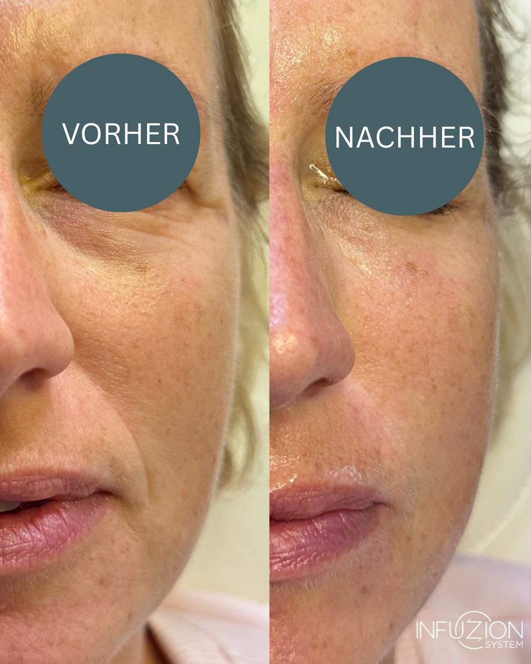 Infuzion – intensive Hautpflege für sichtbar verjüngtes Gesicht im Kosmetikinstitut Villa Kirnach