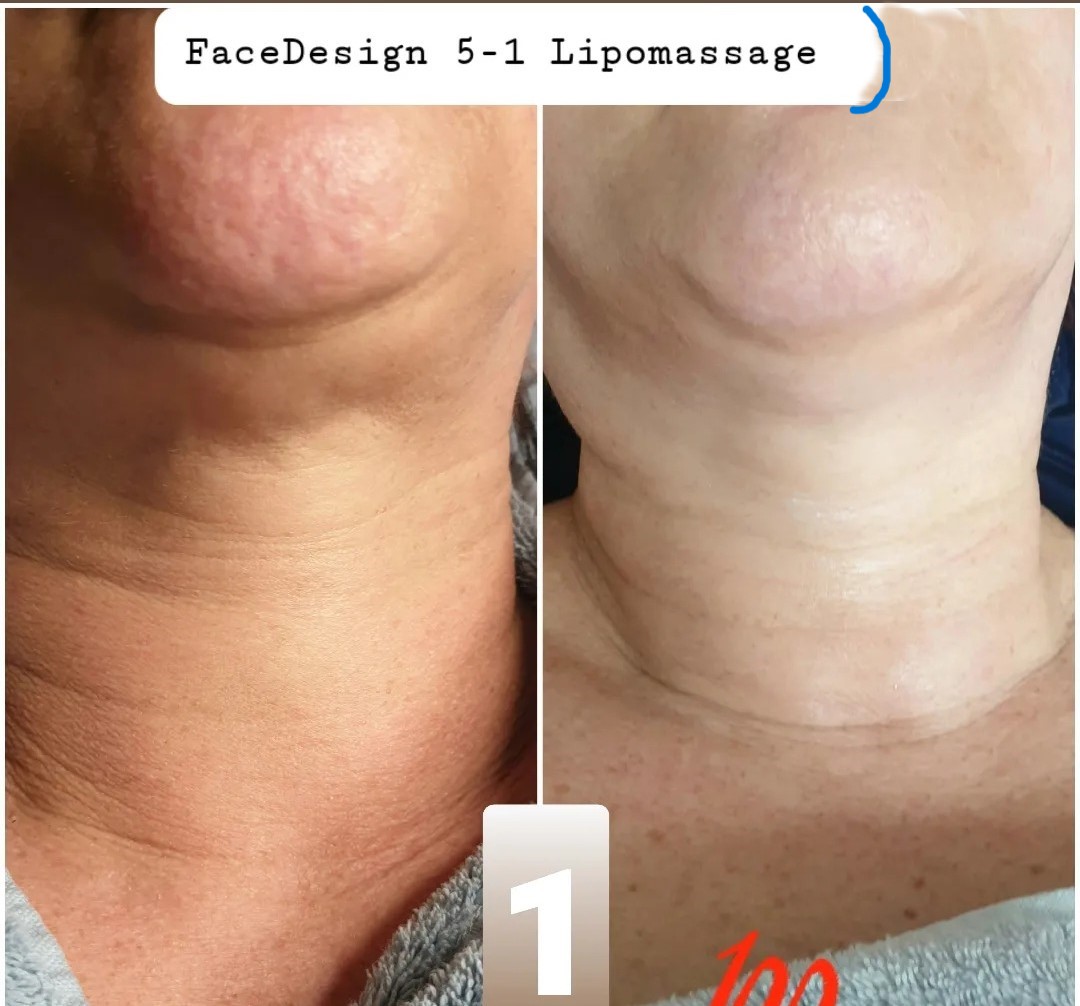 FaceDesign Behandlung – erster Step Splitmassage Bindegewebe im Kosmetikinstitut Villa Kirnach