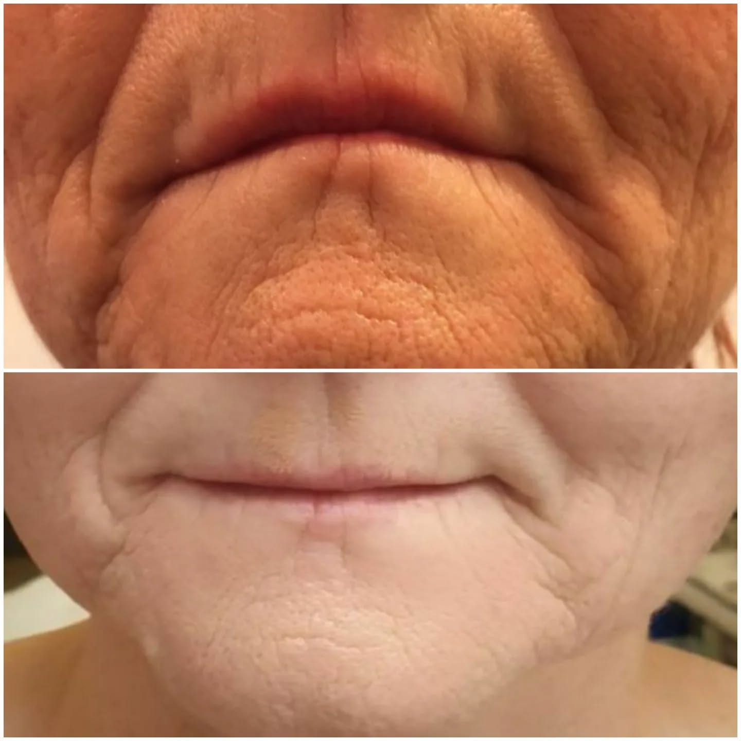 FaceDesign nur nach einer  Behandlung PC Buccal Deep Split&Lifting in der Villa Kirnach 