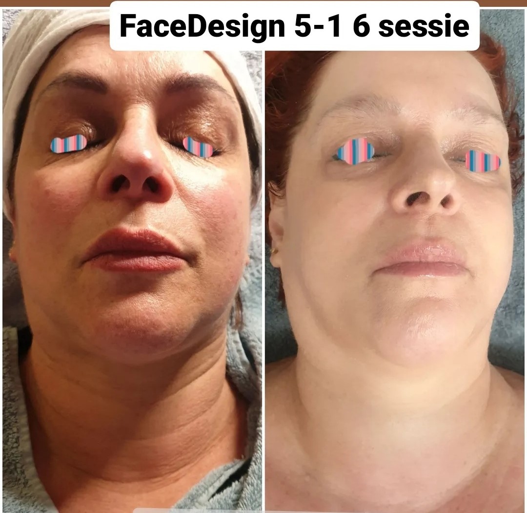 FaceDesign 5-1- 6 Treatments in der Villa Kirnach