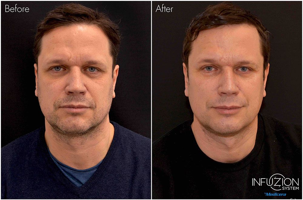 Infuzion System – Filler Effekt für sichtbar mehr Volumen und strahlendes Hautbild im Kosmetikinstitut Villa Kirnach