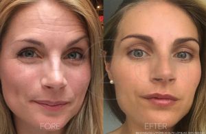 Infuzion System – Filler Effekt für sichtbar mehr Volumen und strahlendes Hautbild im Kosmetikinstitut Villa Kirnach