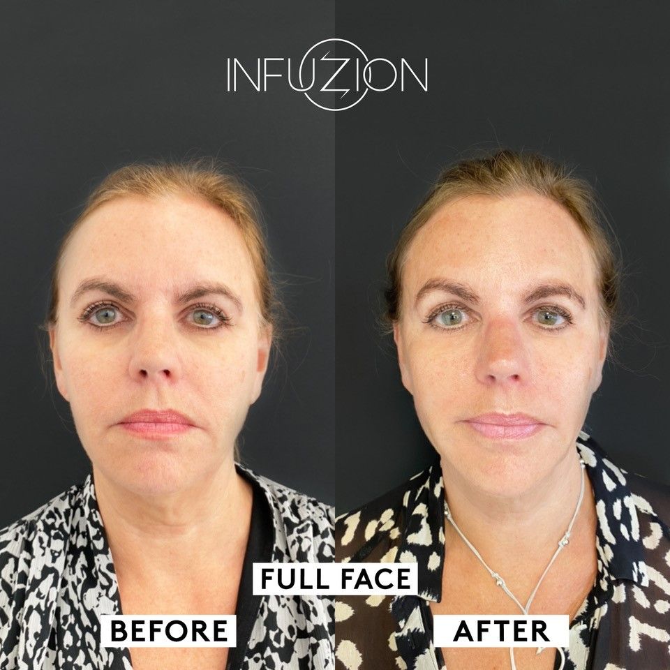 Infuzion – sichtbar glatteres Hautbild nach Behandlung im Kosmetikinstitut Villa Kirnach
