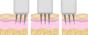 Microneedling