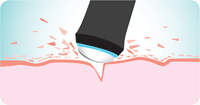 Microdermabrasion – intensive Hauterneuerung im Kosmetikinstitut Villa Kirnach