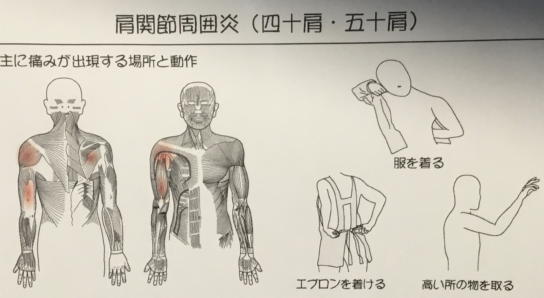 肩の痛み