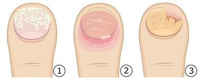 Nagelpilz Behandeln Und Vorbeugen Wege Zur Selbsthilfe