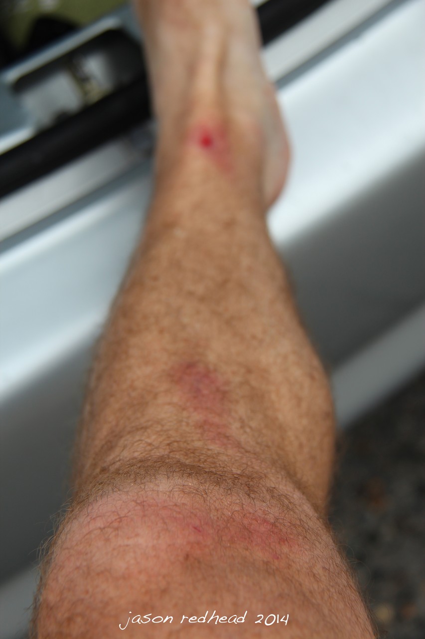  27-02-14 get out before the sharks eat me; my war wounds from an after work surf. its ok though, i can still weight bear on it. i'll still be able to run my marathon next week, maroubra beach, nsw 