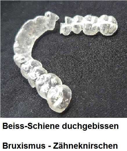 Schiene Zähneknirschen Schiene Zähneknirschen