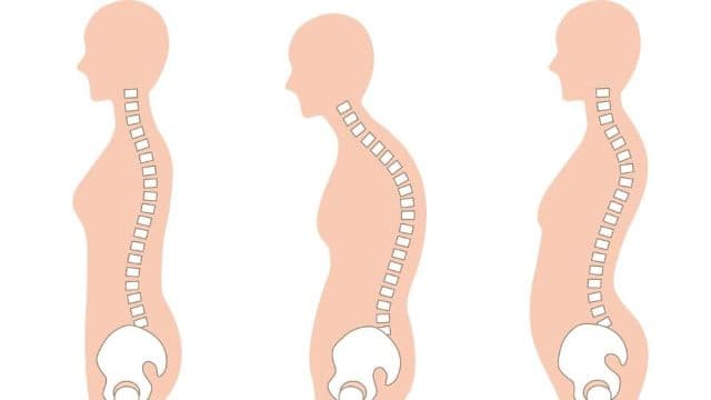 正しい姿勢と猫背･反り腰の違いを示すイラスト|腰痛の原因となる姿勢