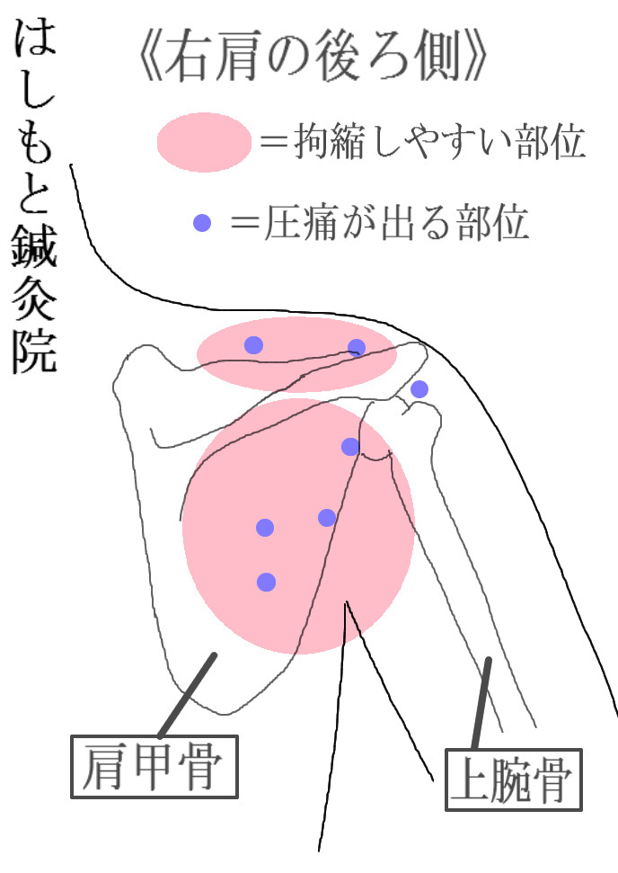 肩関節の痛み(四十肩・五十肩)と鍼灸治療 川口市 はしもと鍼灸院 はしもと鍼灸院(はり灸専門) 健康で快適な毎日