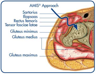 AMIS, Medacta, Quadra, Minimax, Optimys, Allofit, Zimmer, Biomet, Arthrex