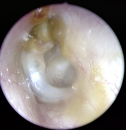 Colesteatoma Dott Francesco Dispenza Otorinolaringoiatria Otorino Palermo