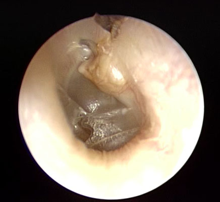 Colesteatoma Dott Francesco Dispenza Otorinolaringoiatria Otorino Palermo