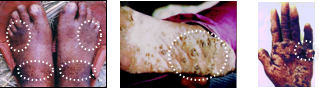 arsenicosis