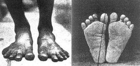 Bildquelle: www.barefootrunningshoes.org / Natürliche Fußform, ohne Schuhe