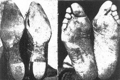 Bildquelle: www.barefootrunningshoes.org / Füße werden durch Schuhe verformt, in Fehlstellungen getrieben und kaputt gemacht