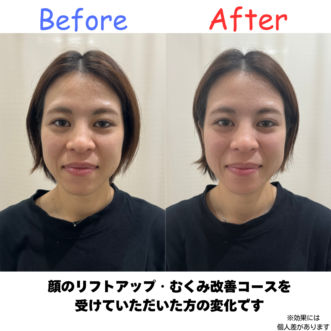 美容鍼施術のビフォーアフター