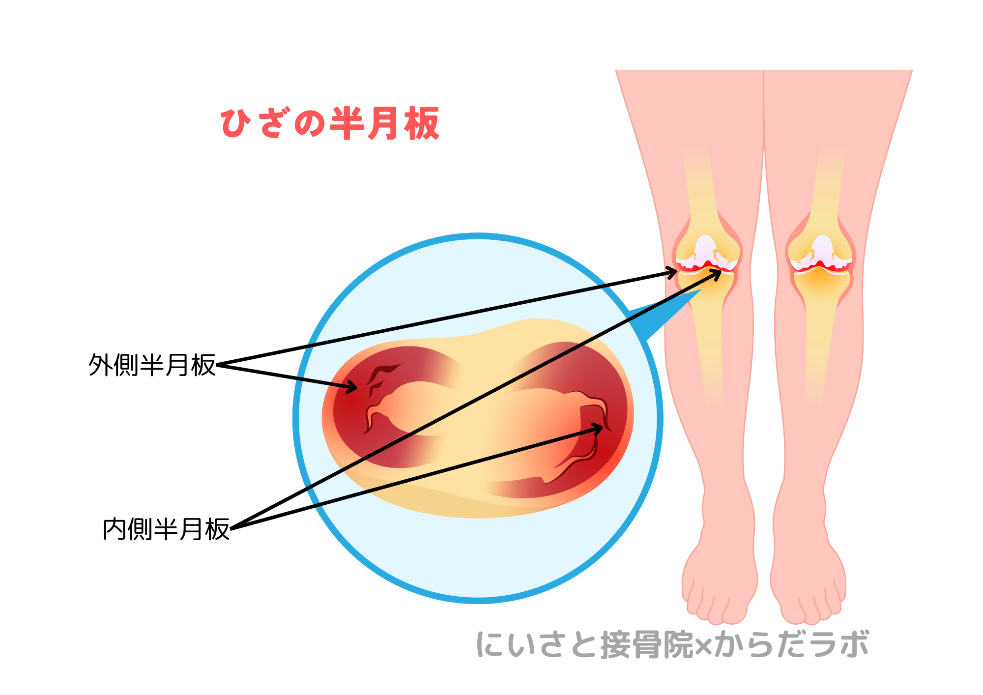 円板状半月板による膝の痛みについて【やさしい解説】