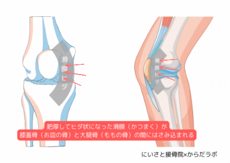 滑膜ヒダが膝蓋骨と大腿骨に挟まれることで痛みが生じる