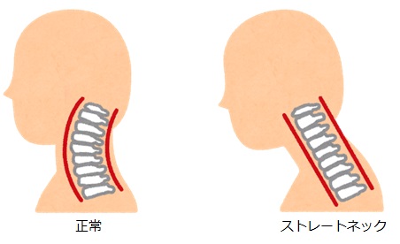 正常な頸椎とストレートネック