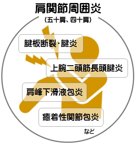 五十肩の種類