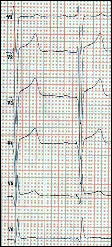 EKG CRT Biventrikuläre Stimulation Brustwandableitungen