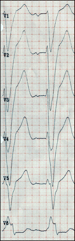 EKG CRT Biventrikuläre Stimulation Extremitätenableitungen